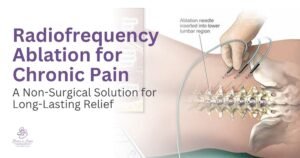Radiofrequency Ablation for Chronic Pain – A Non-Surgical Solution for Long-Lasting Relief